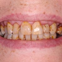 Dental Veneers - Smile 15 before